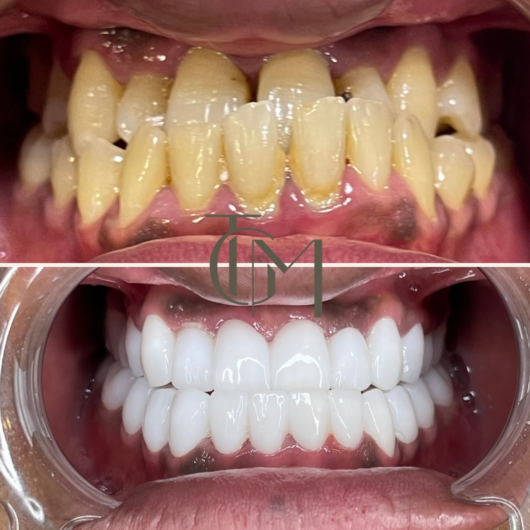 Real dental before and after result from The Glow Med, before on top and after below