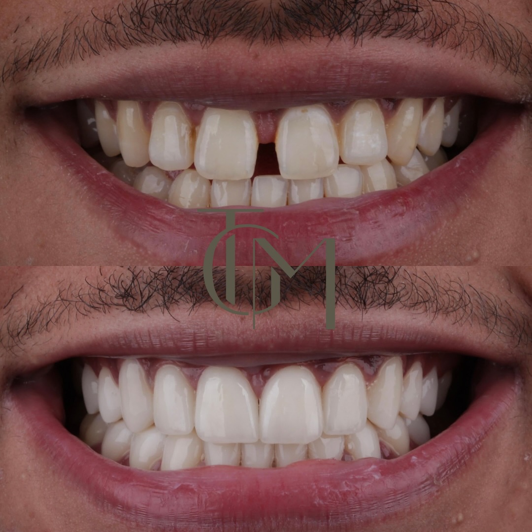 Dental before and after — patient result, before on top and after below