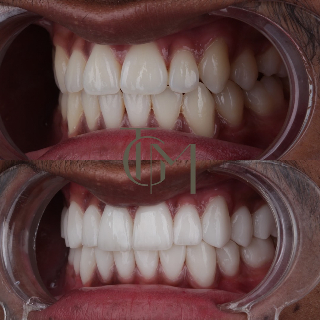 Dental before and after — patient result, before on top and after below