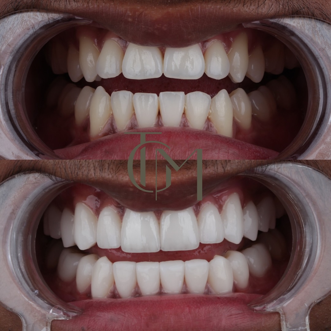 Dental before and after — patient result, before on top and after below
