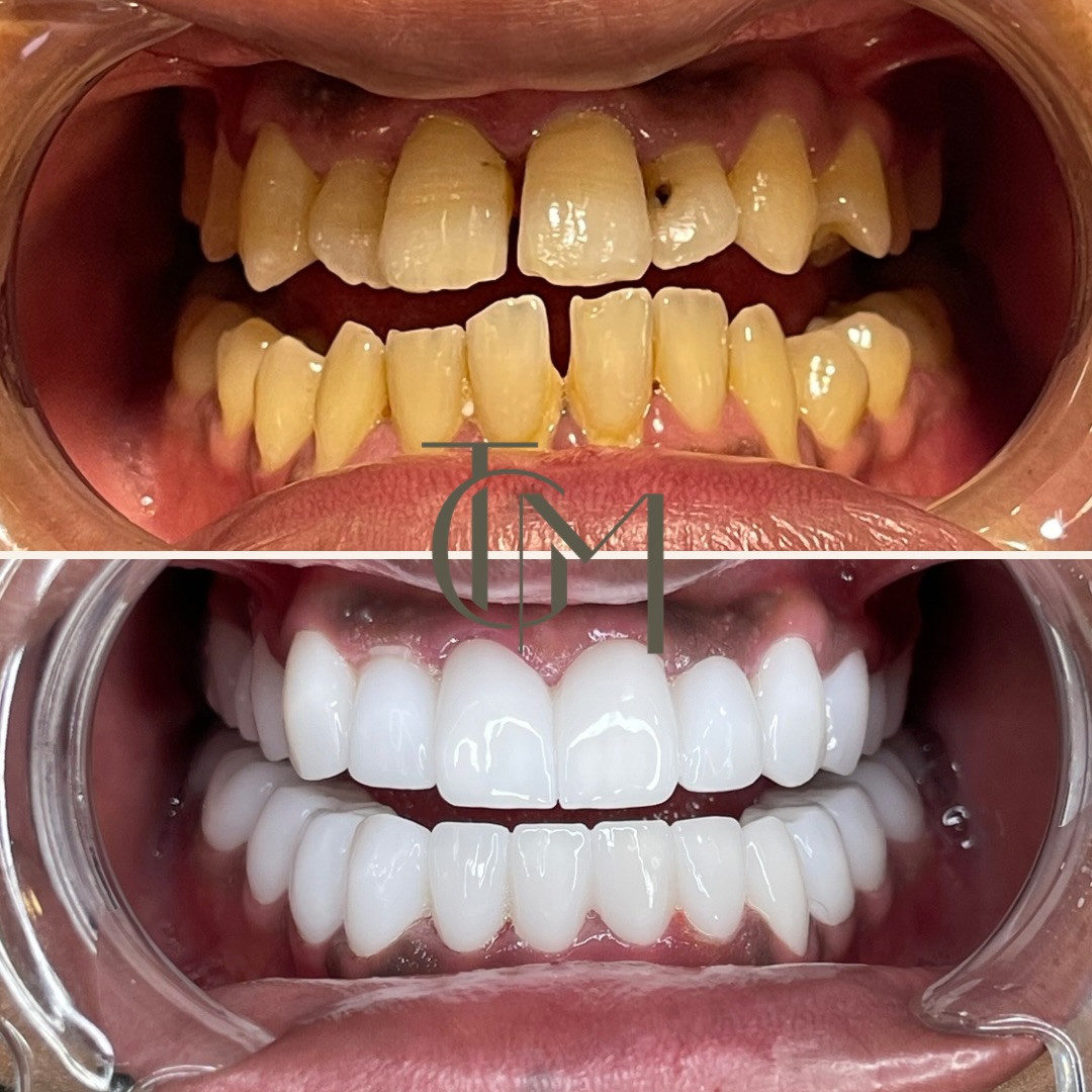 Dental before and after — patient result, before on top and after below