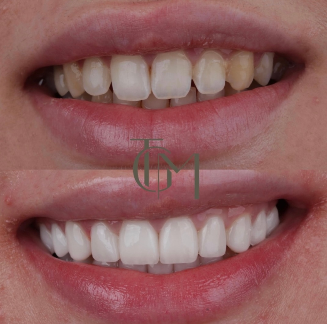 Dental before and after — patient result, before on top and after below
